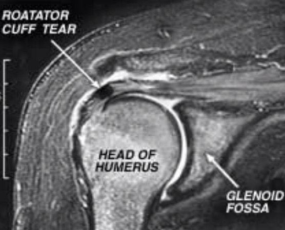 Rotator Cuff